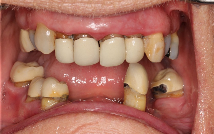 Before AccuFrame Overdenture Installation